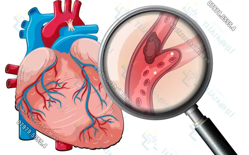 Người bệnh nhồi máu cơ tim nên ăn gì và thay đổi lối sống ra sao?