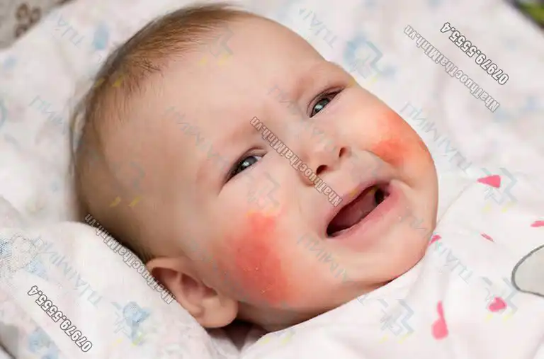 Bệnh chàm: Thường xảy ra phổ biến ở trẻ sơ sinh và trẻ nhỏ, và nó thường tái phát thường xuyên cho đến khi trưởng thành. Đây là một tình trạng mãn tính, thường gây Khô da, Mẩn đỏ và Tạo cảm giác châm chích, ngứa ngáy trên vùng da mặt và cả da tay, chân.
