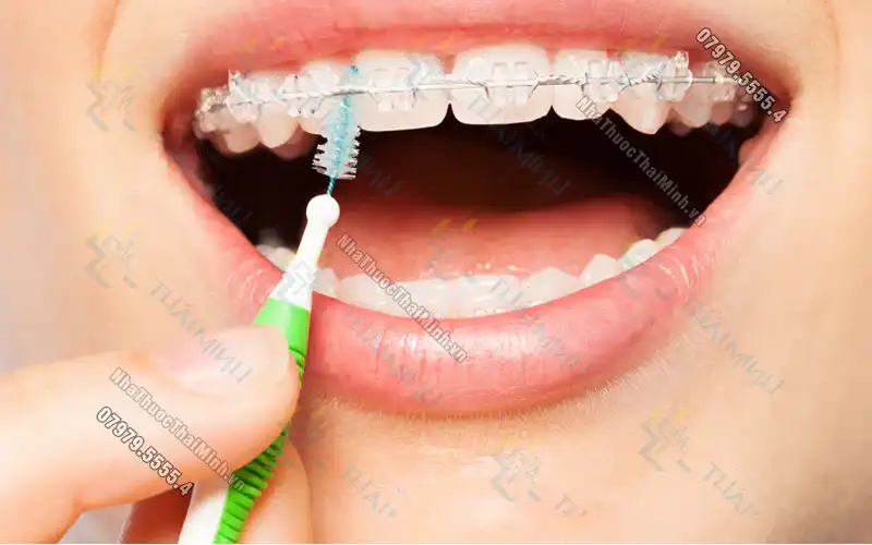 Niềng răng có nên dùng bàn chải điện không?