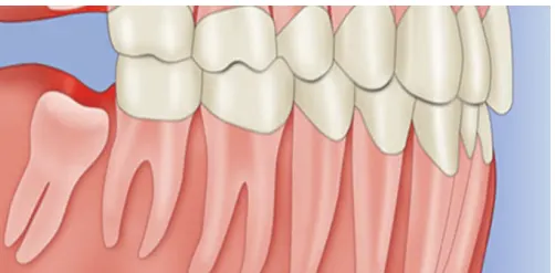 Mọc răng khôn là điều xảy ra ở rất nhiều người trưởng thành, quá trình này sẽ làm ảnh hưởng đến cuộc sống thường ngày. Ngoài ra, nó còn làm suy giảm chức năng ăn nhai và vệ sinh răng miệng của nhiều người. Vậy mọc răng khôn nên uống thuốc giảm đau nào hiệu quả? 