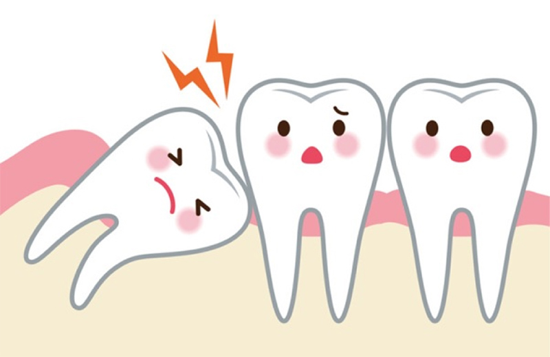 Cách giảm đau răng khôn bị sâu tại nhà