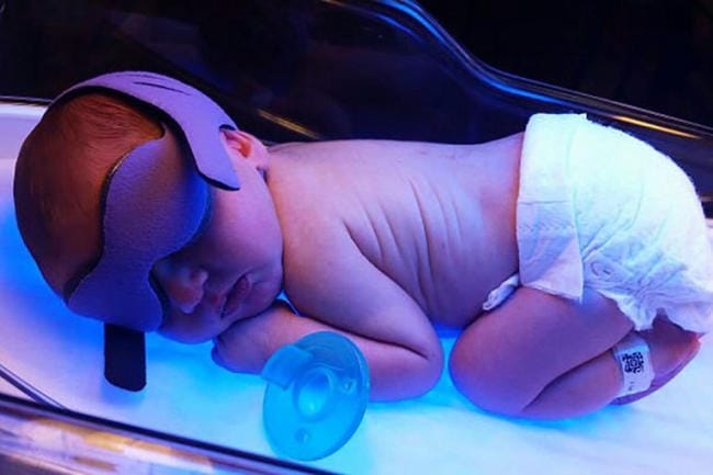 Chiếu đèn vàng da cho trẻ sơ sinh có ảnh hưởng gì không?