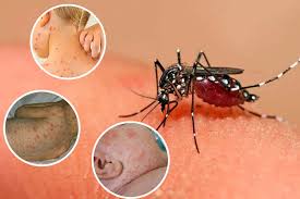 Sốt xuất huyết là bệnh truyền nhiễm cấp tính do muỗi vằn gây ra. Bệnh có nguy cơ gia tăng mạnh vào mùa mưa và ở những nơi có môi trường không đảm bảo vệ sinh như ao tù nước đọng, rừng rậm. Bệnh có thể lây từ người sang người.
