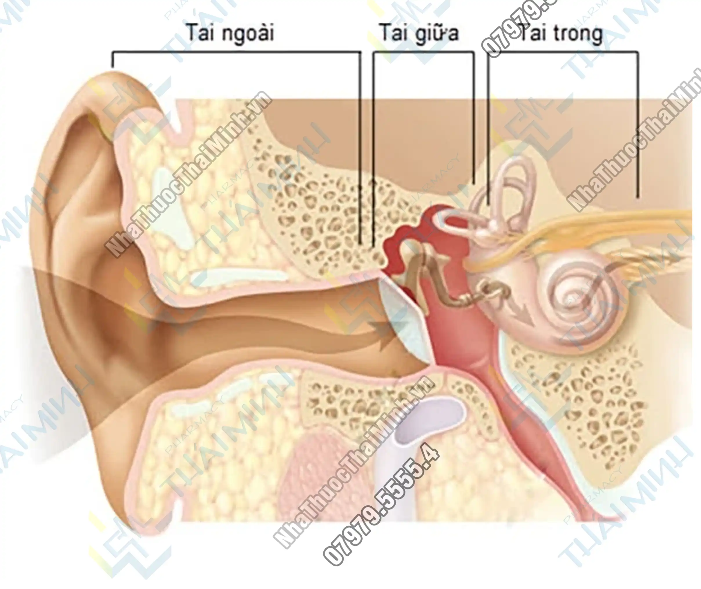 Dạng nhẹ của viêm tai trong là kết quả của nhiễm trùng vi khuẩn trong tai giữa (viêm tai giữa mạn tính). Nếu không được điều trị, viêm tai giữa mạn tính có thể tiến triển và lan sang tai trong, gây ra viêm tai trong.