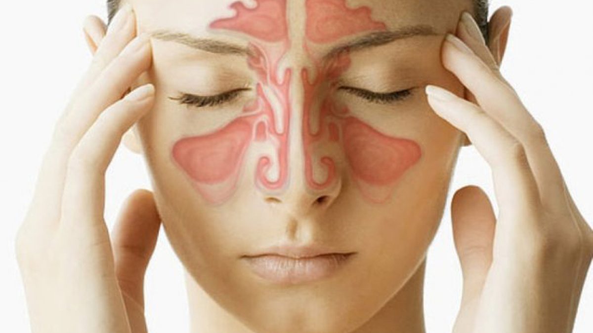 iêm xoang là một trạng thái khi xoang mũi bị nhiễm trùng, phình to, viêm phản ứng dẫn đến mủ và chất viêm tích tụ trong các khoang. Đây là một căn bệnh khá phổ biến hiện nay.