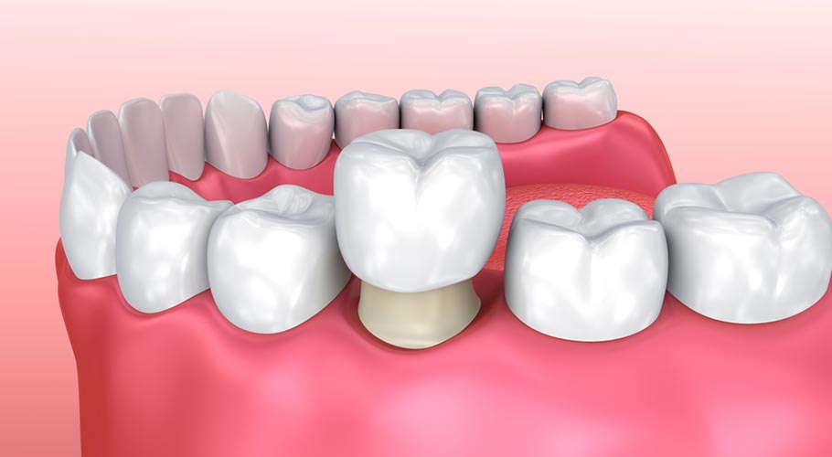 Tổng hợp những trường hợp không nên bọc răng sứ bạn cần biết