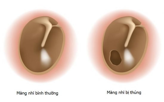 Cảnh giác trước các dấu hiệu thủng màng nhĩ