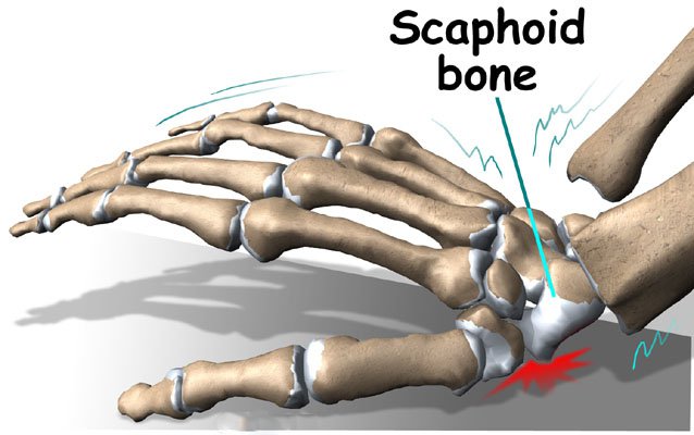 Gãy xương cổ tay cần kiêng gì để nhanh hồi phục 