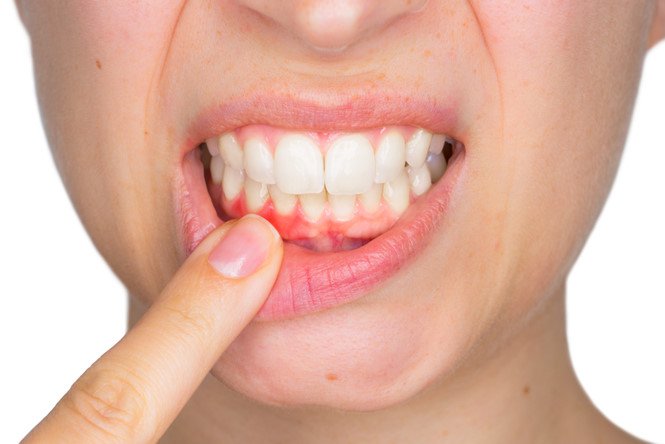Nguyên nhân và cách điều trị sưng nướu răng hàm dưới trong cùng