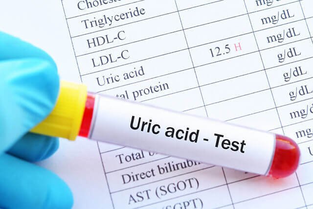 Chỉ số acid uric máu bao nhiêu là bị Gout?