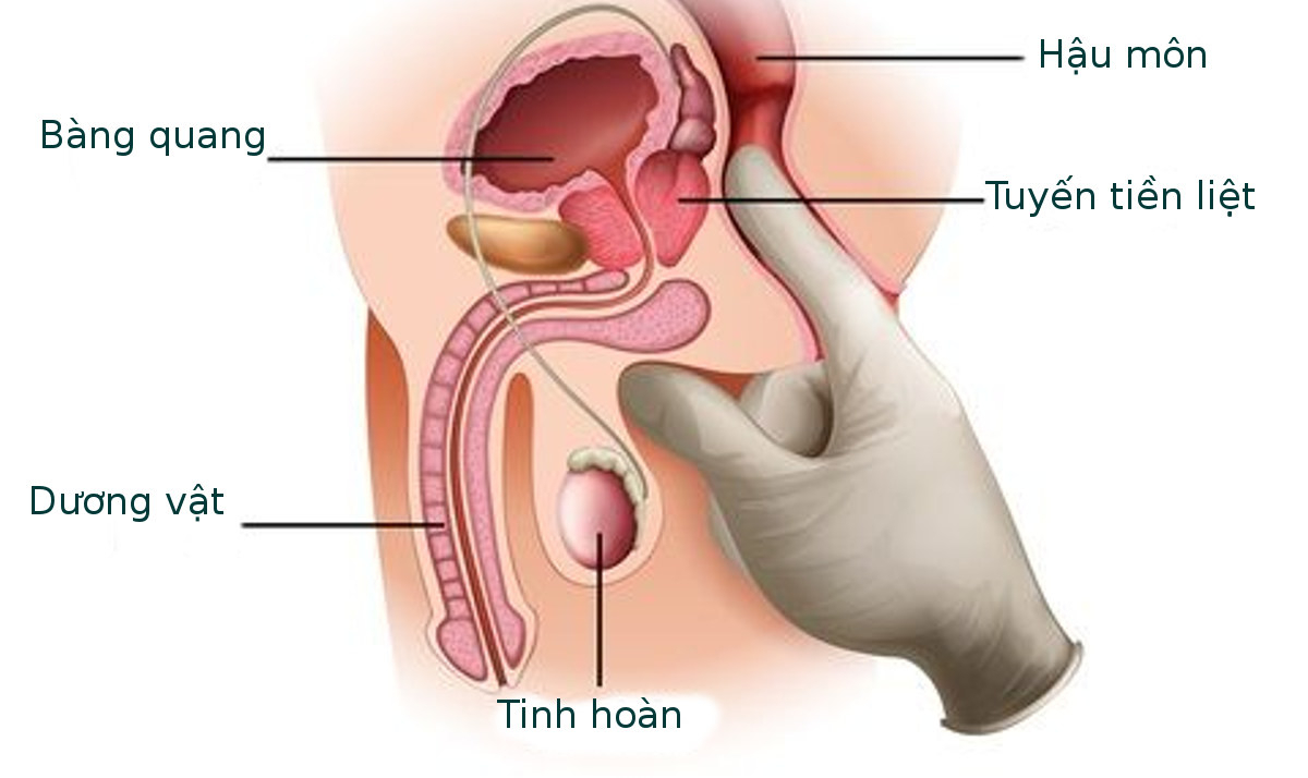 Cách chữa viêm tuyến tiền liệt hiệu quả hiện nay