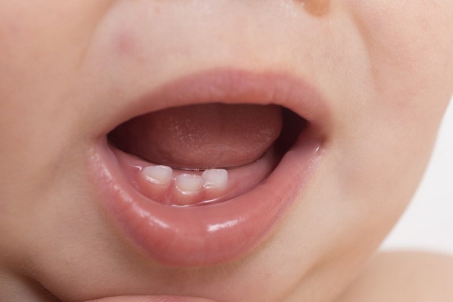 Góc giải đáp: 1 chiếc răng sữa mọc trong bao lâu?