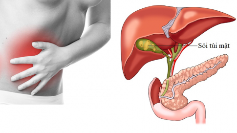 Tìm hiểu về túi mật và sỏi túi mật? Nguyên nhân hình thành sỏi túi mật và cách điều trị