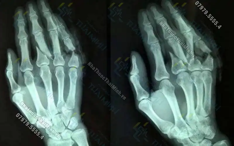 Bị đau khớp cổ tay thường xuyên có nguy hiểm không?