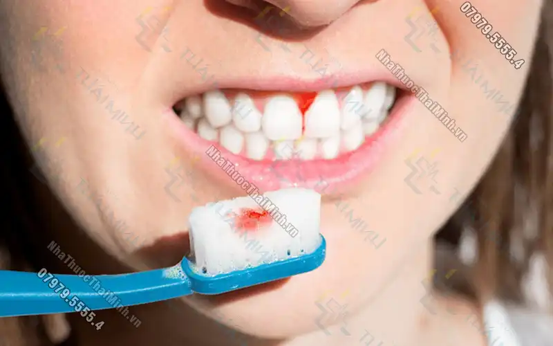 Chảy máu răng không cầm được: Một dấu hiệu nguy hiểm
