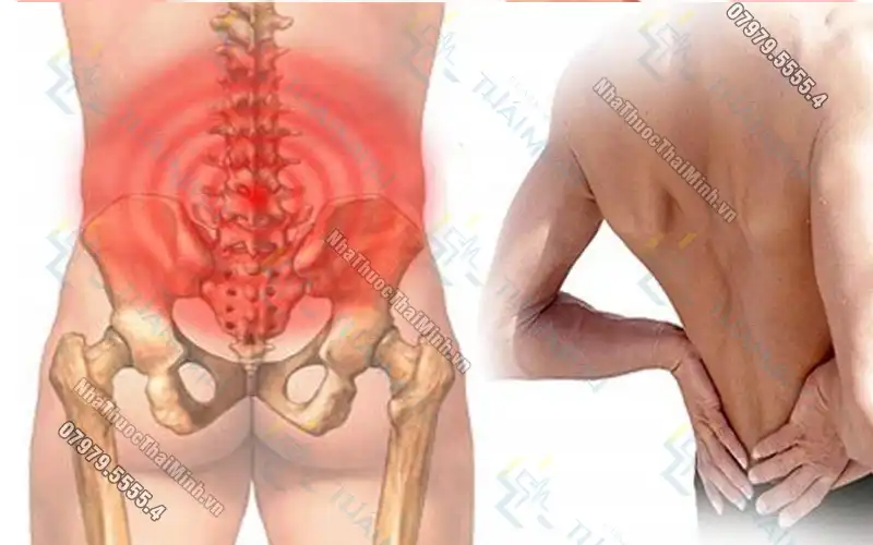 Chớ lơ là triệu chứng đau vùng mông gần xương cụt
