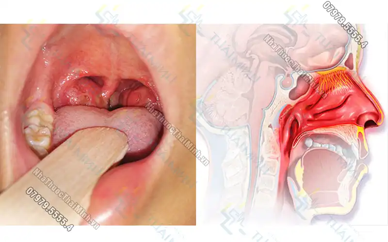 Chữa viêm VA bằng đông y cho trẻ có hiệu quả không?