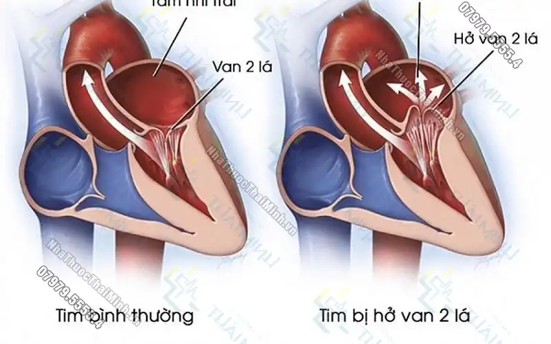 Hở van tim 2 lá 1/4 là gì? Bệnh hở van tim 2 lá 1/4 có nguy hiểm không?