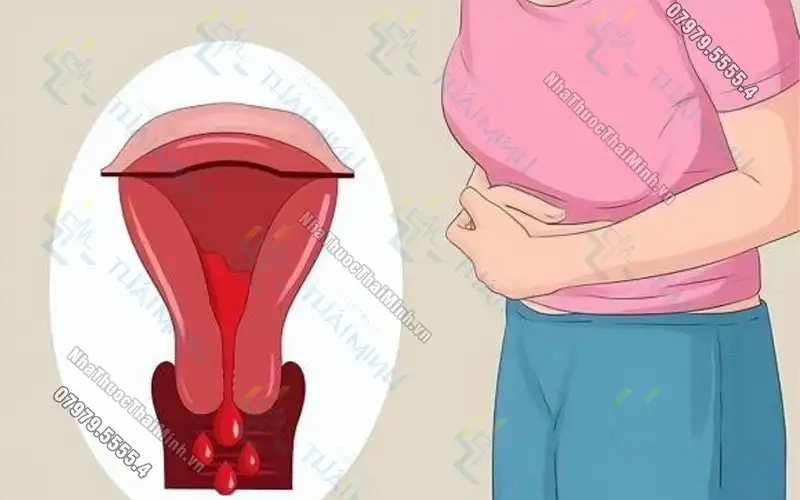 Kinh nguyệt ra máu đông nhìn như bào thai có phải sảy thai?