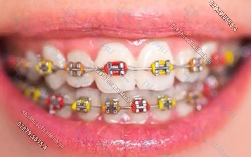 Niềng răng cho trẻ em: Những vấn đề bạn cần nên biết