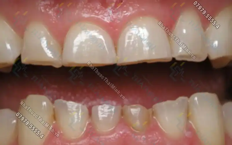 Răng bị mòn mặt nhai là gì? Cách khắc phục răng bị mòn?