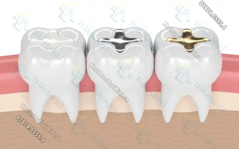 Ưu nhược điểm của phương pháp trám răng composite