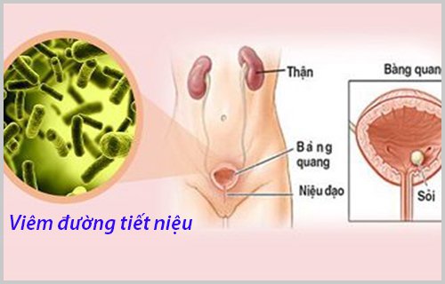 Viêm đường tiết niệu ở nữ có gây vô sinh không? Biểu hiện bệnh mà bạn nên biết