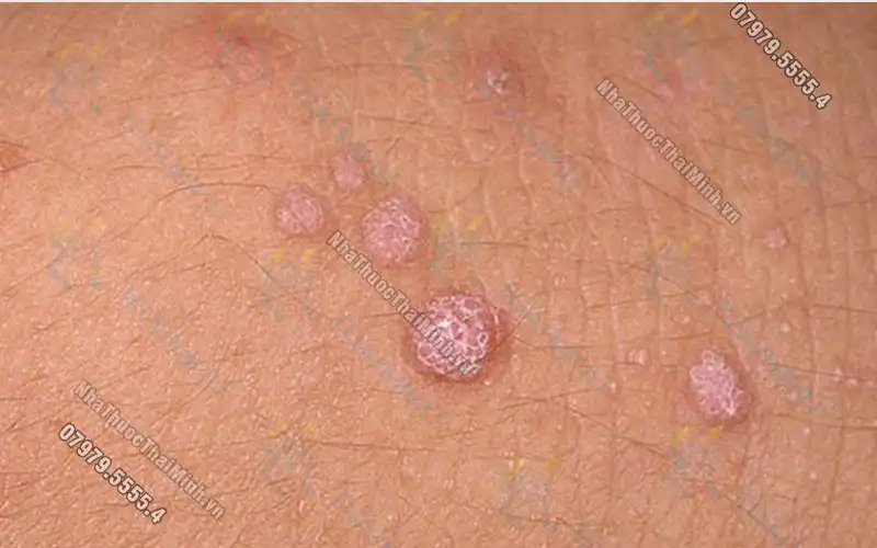 Virus HPV lây qua đường nào và gây ra những bệnh gì?
