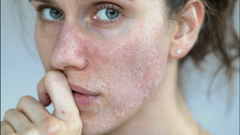 Da mặt bị khô sần và ngứa phải làm như thế nào?