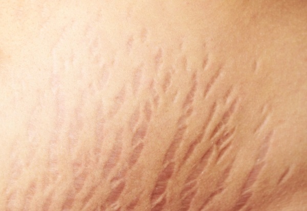 Rạn da ở nam giới có chữa được không?