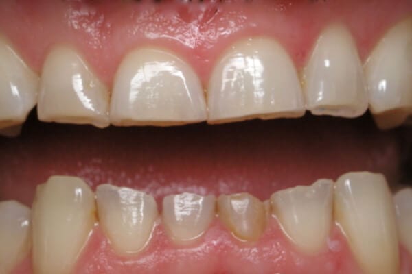 Răng bị mòn mặt nhai là gì? Cách khắc phục răng bị mòn?