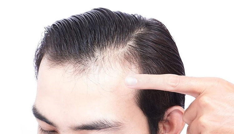 Dấu hiệu và nguyên nhân khiến bạn bị hói đầu khi còn trẻ? Hói đầu di truyền có chữa được không?