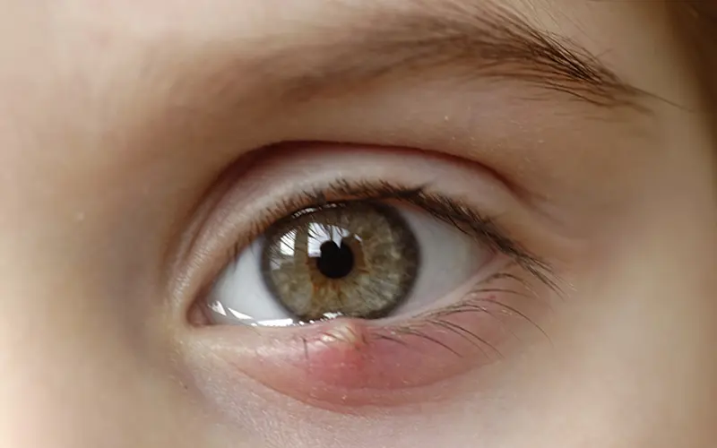 Cách chăm sóc mắt sau khi chích lẹo hiệu quả? Tìm hiểu chung về lẹo mắt