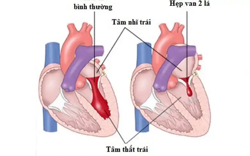 Bệnh van tim là gì? Vai trò quan trọng của van tim đối với cơ thể con người