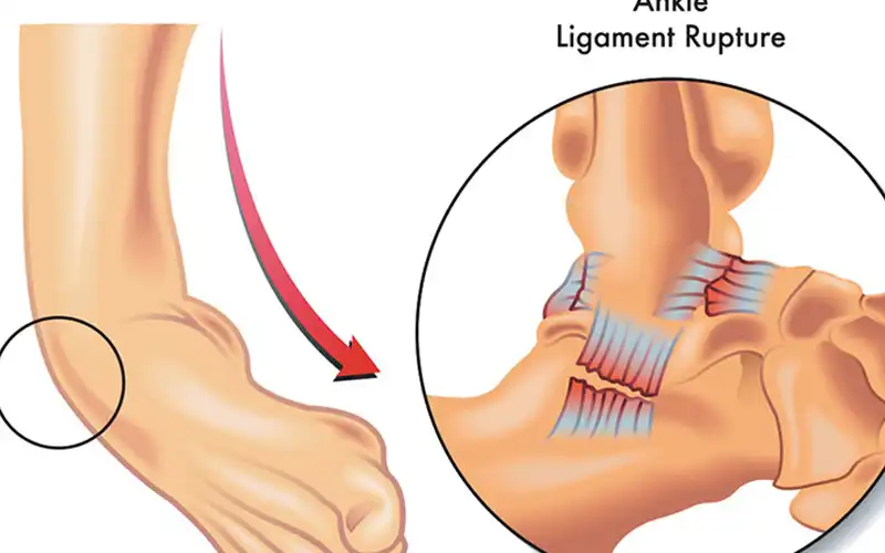 Đứt dây chằng là gì? Bị đứt dây chằng cổ chân có phải mổ không?