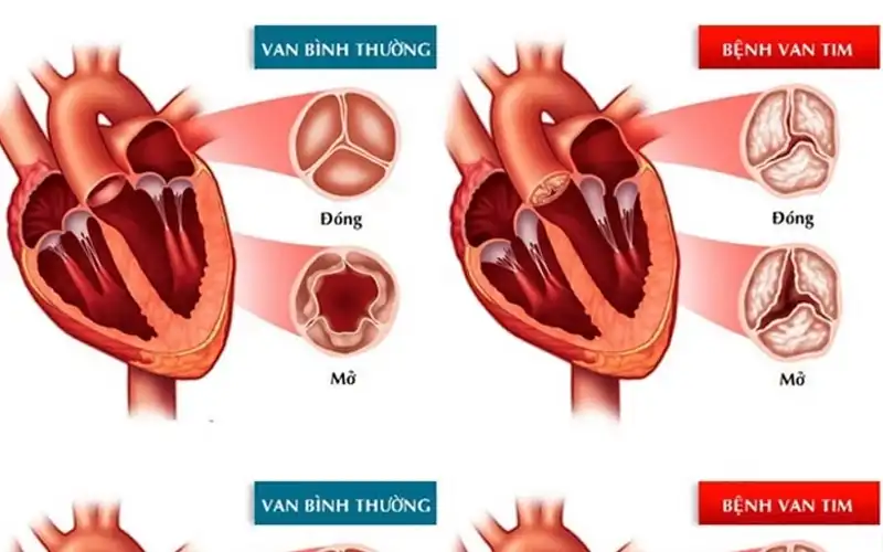 Nguyên nhân hở van tim là gì? Bệnh hở van tim có nguy hiểm không?