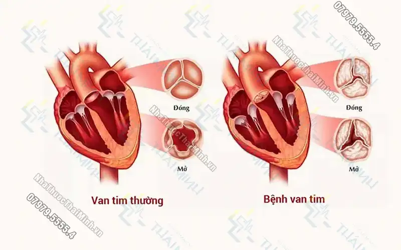 Hở van 2 lá có nguy hiểm không? Hở van 2 lá là gì?