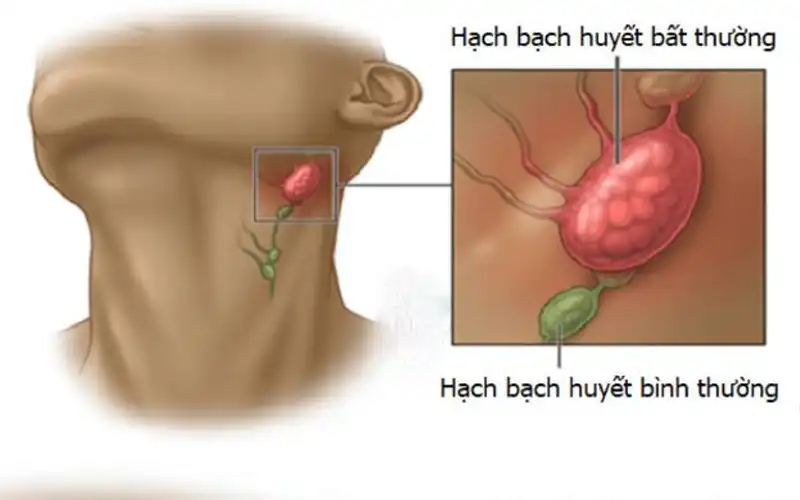 Ung thư hạch bạch huyết là gì? Bệnh nhân cần lưu ý gì khi mắc bệnh?