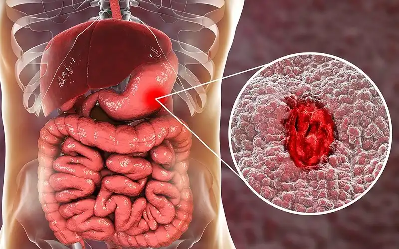 Các dấu hiệu viêm loét dạ dày mà bạn nên lưu ý