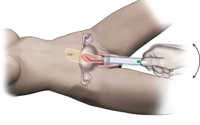 Góc giải đáp: Siêu âm đầu dò có phát hiện ung thư cổ tử cung không?