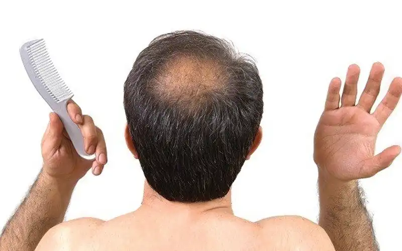 Nguyên nhân gây rụng tóc ở nam? Cách khắc phục thế nào?