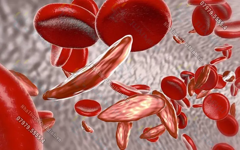 Góc giải đáp: Thiếu máu hồng cầu nhỏ nên ăn gì?