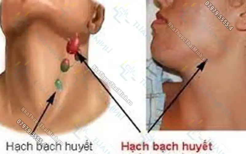 Ung thư hạch bạch huyết là gì? Bệnh nhân cần lưu ý gì khi mắc bệnh?