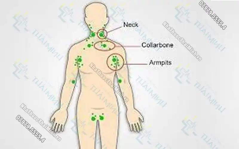 Ung thư hạch bạch huyết là gì? Bệnh nhân cần lưu ý gì khi mắc bệnh?