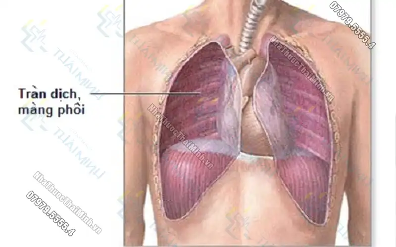 Viêm phổi cộng đồng là gì?