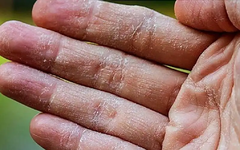 Góc giải đáp: Da tay bị bong tróc là thiếu chất gì?