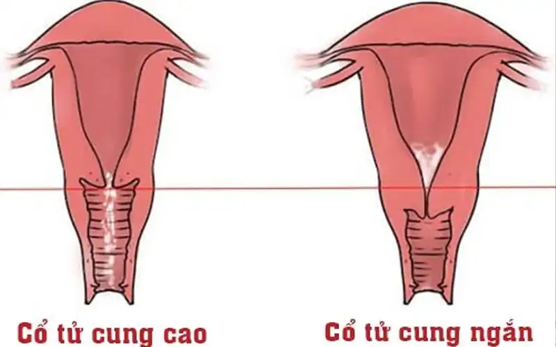 Cổ tử cung ngắn là gì? Cổ tử cung ngắn khi mang thai và cách điều trị