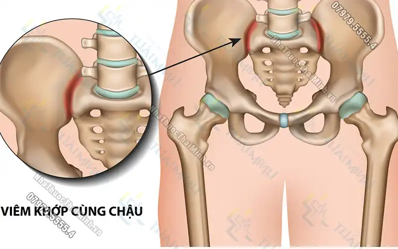 Nguyên nhân và cách khắc phục hiệu quả triệu chứng đau hông khi ngủ