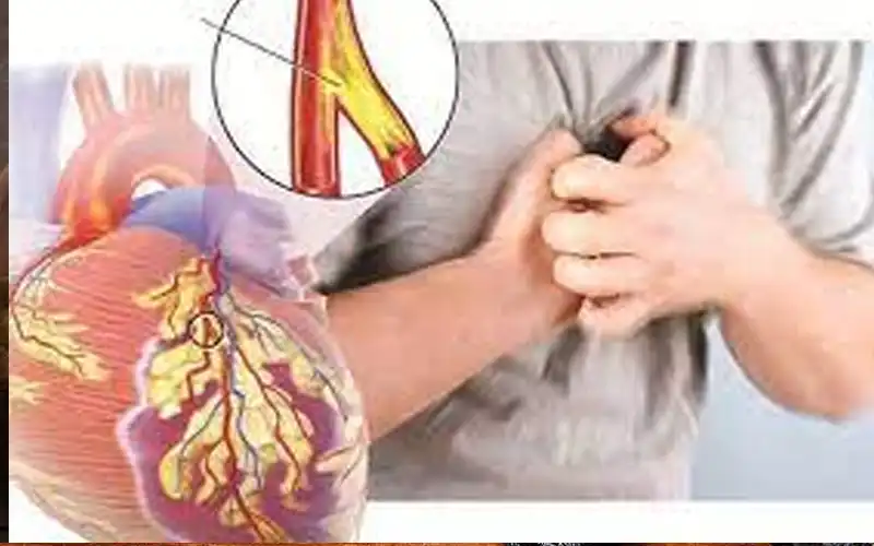 Hẹp mạch vành là gì? Triệu chứng, phân loại và mức độ nguy hiểm