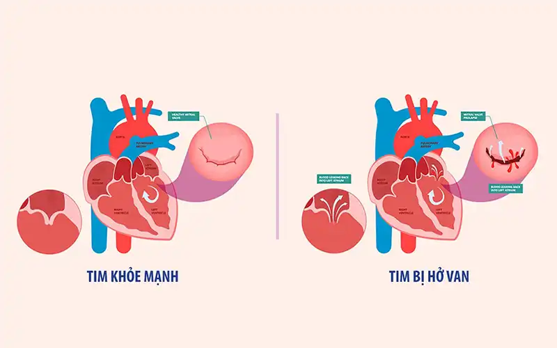 Hở van 2 lá có nguy hiểm không? Hở van 2 lá là gì?